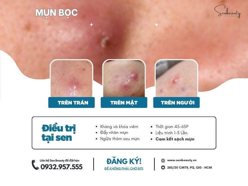 Trị các loại mụn nhọt trứng cá có cam kết